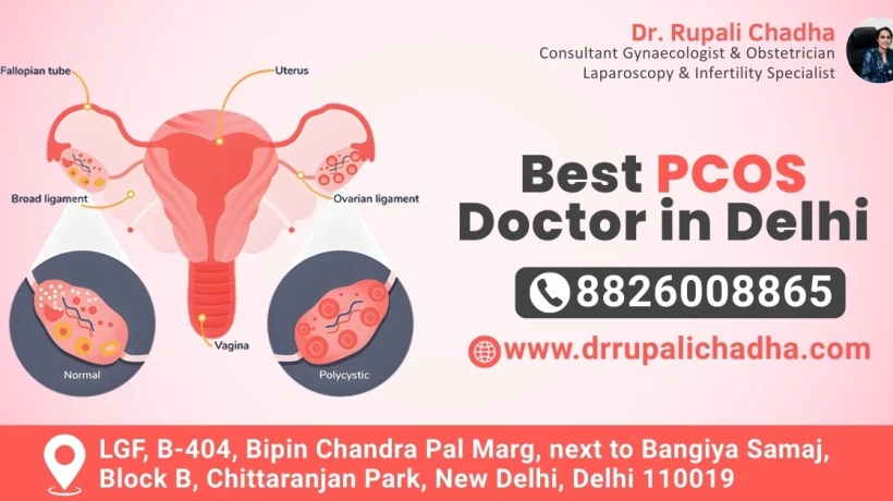 Best PCOS Doctor in Delhi: Personalized Treatment That Works